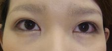 眼瞼下垂（目チカラアップ術） 施術後