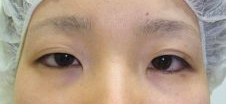 眼瞼下垂（目チカラアップ術） 施術前
