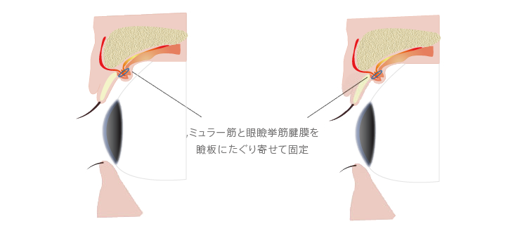 タレ目形成術（下眼瞼下制術）の施術方法