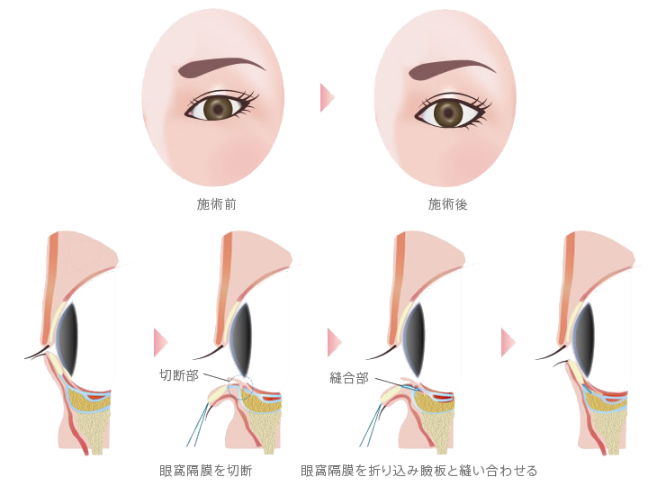 タレ目形成術（下眼瞼下制術）の施術方法