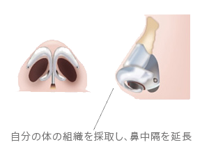 鼻中隔延長術の施術方法