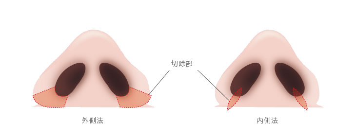 鼻翼形成術 施術方法