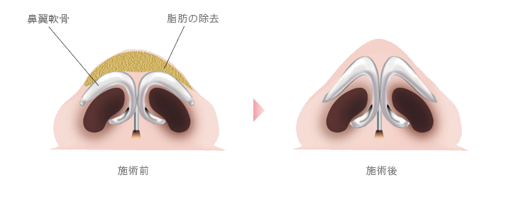鼻尖形成術 施術方法