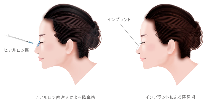 隆鼻術 施術方法