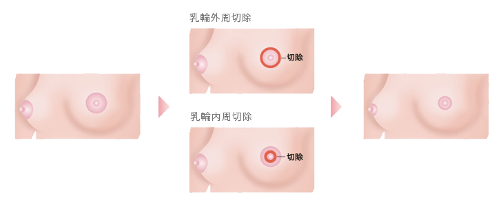 乳輪縮小術 施術方法