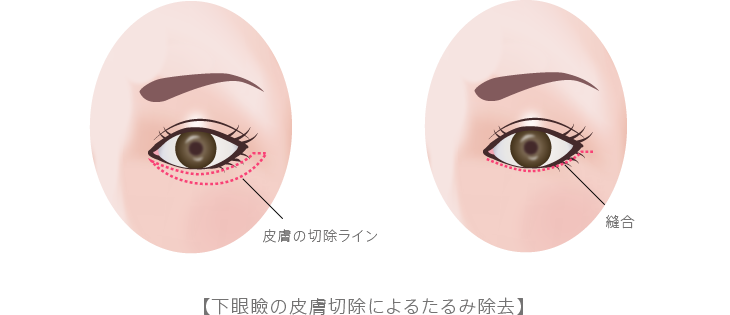 下眼瞼の皮膚切除によるたるみ除去(下眼瞼除皺術)