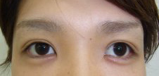眼瞼下垂の治療後