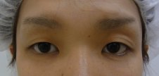 眼瞼下垂の治療前
