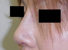 隆鼻術、鼻尖形成術施術後