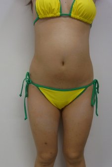 脂肪吸引（腹+ウエスト+腰+大腿内側）施術前