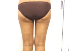 脂肪吸引 大腿全周 臀部 膝 後面より施術後