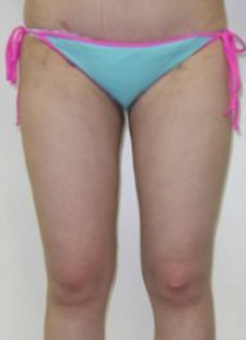 脂肪吸引　大腿+臀部+膝施術後